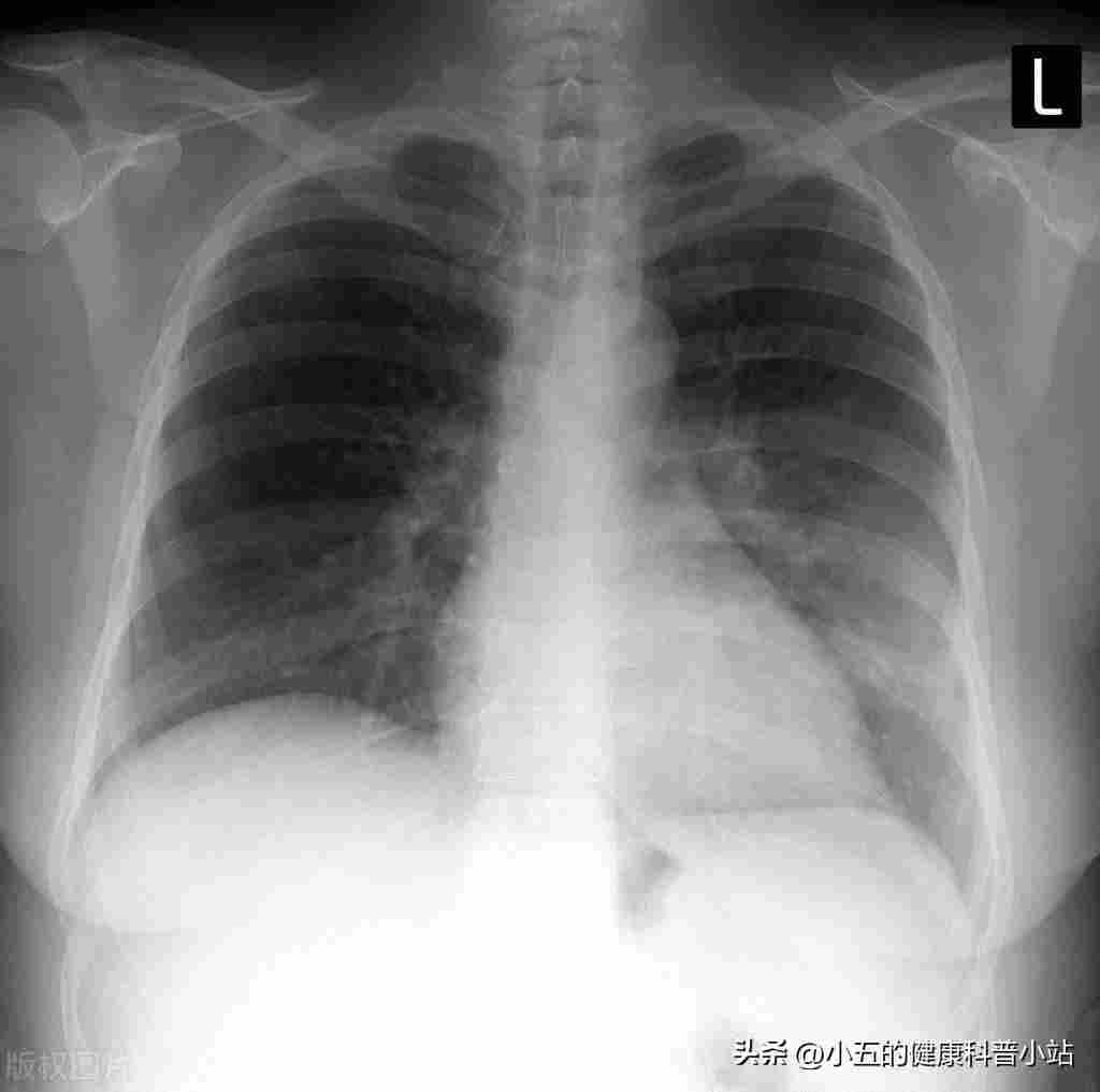 桉柠蒎肠溶胶囊常用于治疗肺炎、支气管炎，科学服用注意这4点